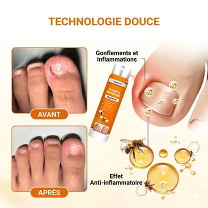 Spray antifongique NailFree™ | 99 % des mycoses des ongles disparaissent en seulement 7 jours