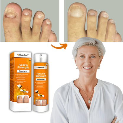 Spray antifongique NailFree™ | 99 % des mycoses des ongles disparaissent en seulement 7 jours