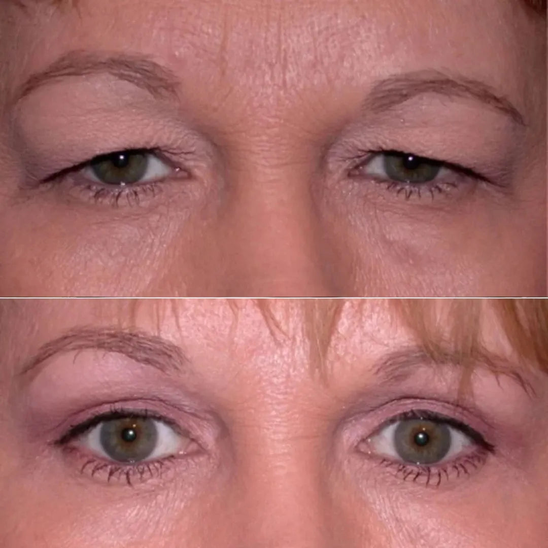 Luminelle™ | Pour un regard plus frais et plus ouvert, sans ruban adhésif ni intervention.