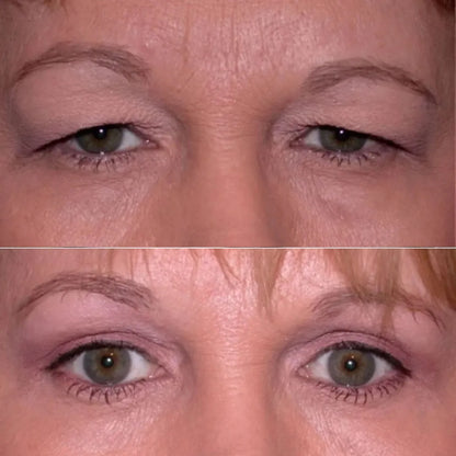 Luminelle™ | Pour un regard plus frais et plus ouvert, sans ruban adhésif ni intervention.