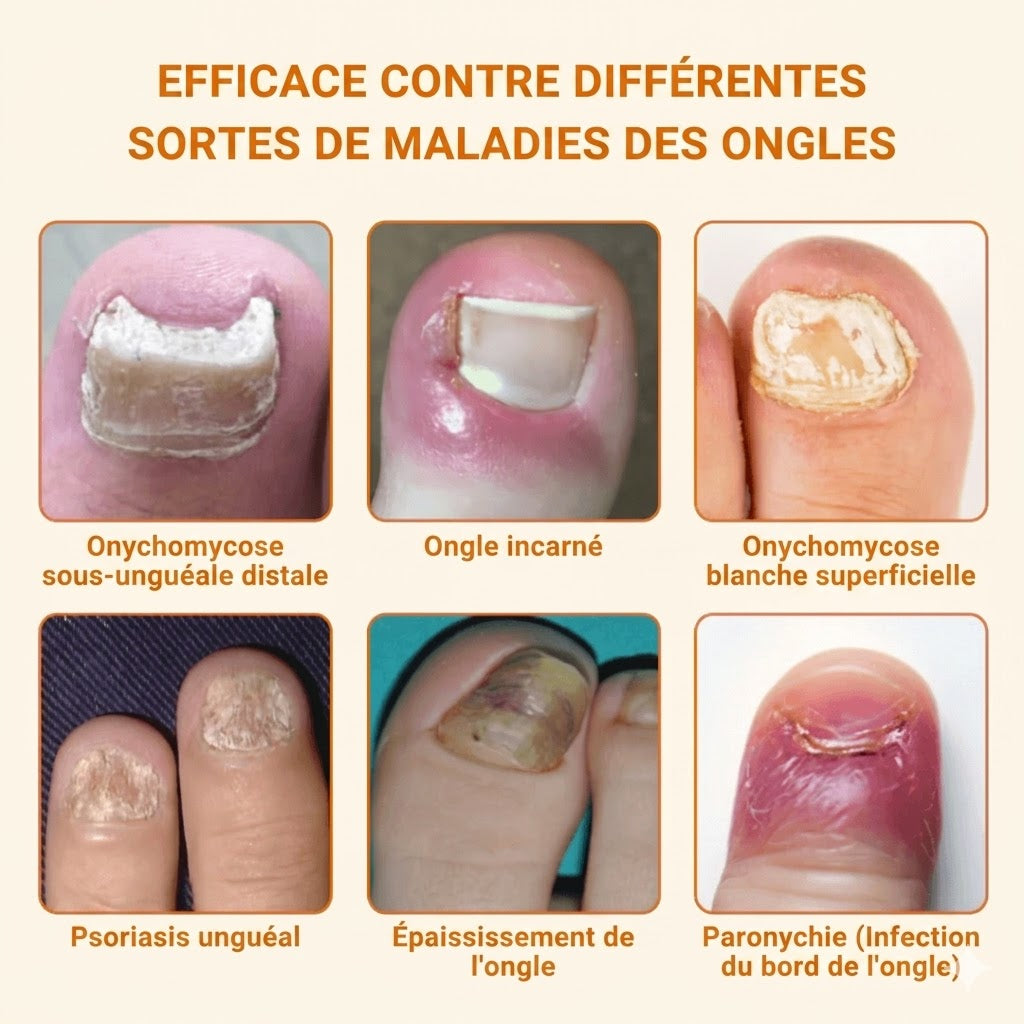 Spray antifongique NailFree™ | 99 % des mycoses des ongles disparaissent en seulement 7 jours