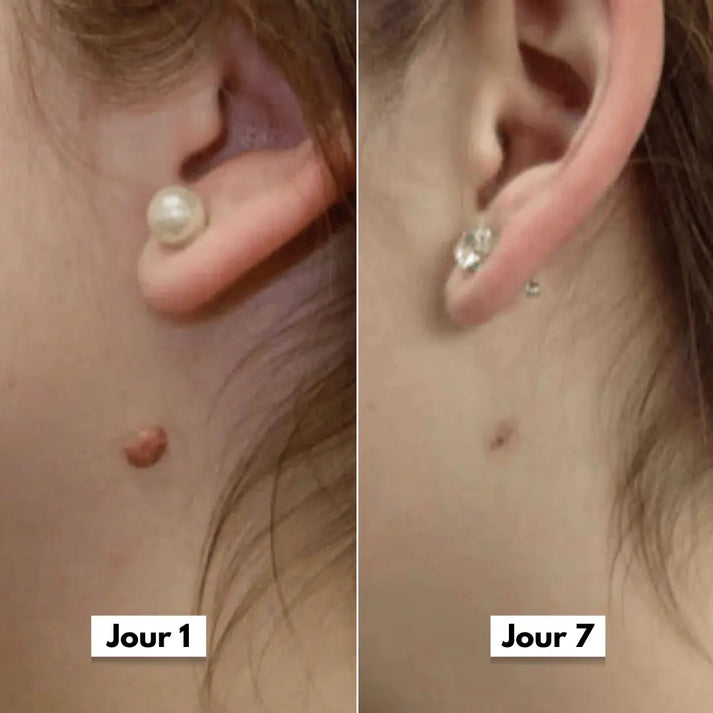 DermaSkin Pro™ - Adieu les acrochordons