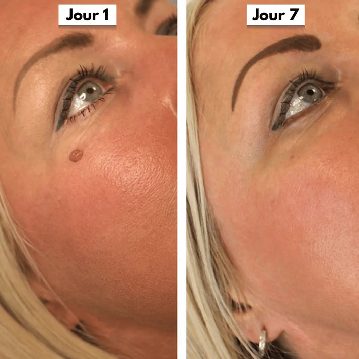 DermaSkin Pro™ - Adieu les acrochordons
